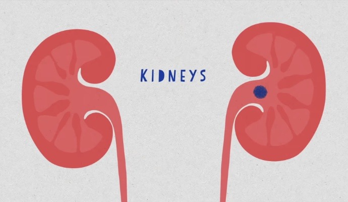 Kidney Stones