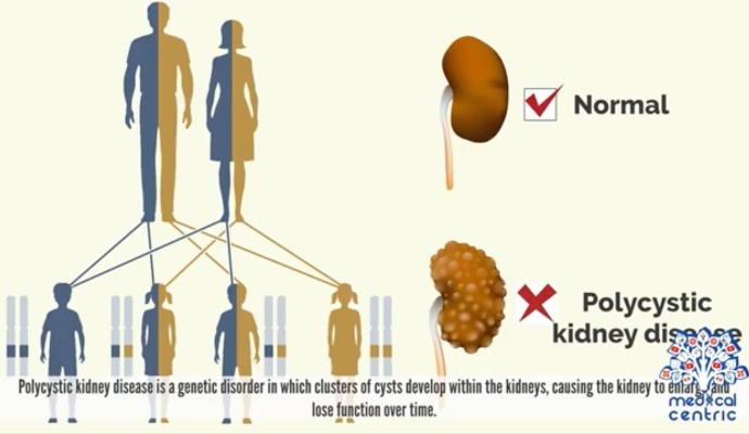 Other Kidney Cysts